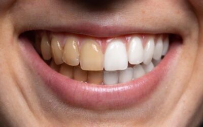¿Cómo prevenir los dientes amarillos?